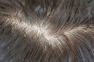 Is It Bad to Scratch Your Scalp When You Shampoo?